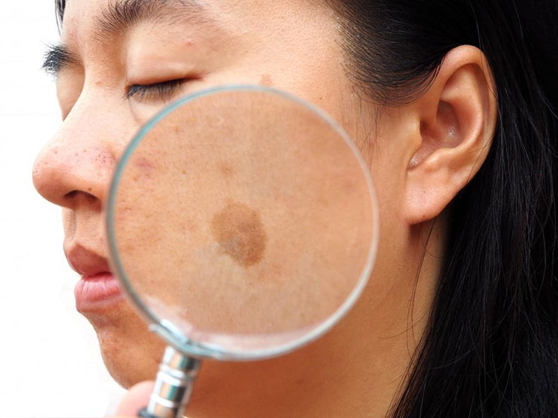 Pikosekundás lézer: jó segítő a melasma eltávolításához