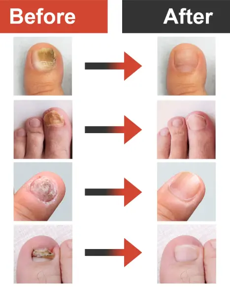 980nm 1470nmdiode Laser Lipolysis Machine